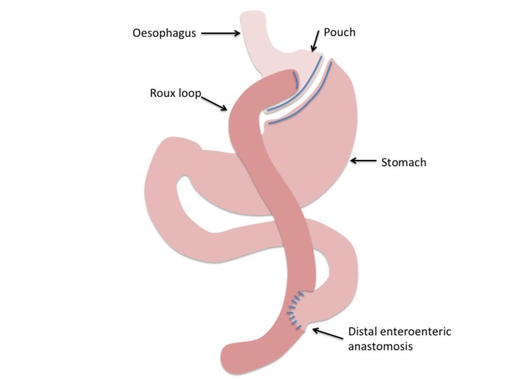 Fig. 12: Roux-en-Y gastric bypass References: - Leeds/UK Normal post-operative imaging: Water-soluble swallow may be performed post surgery to assess integrity of the gastric pouch and