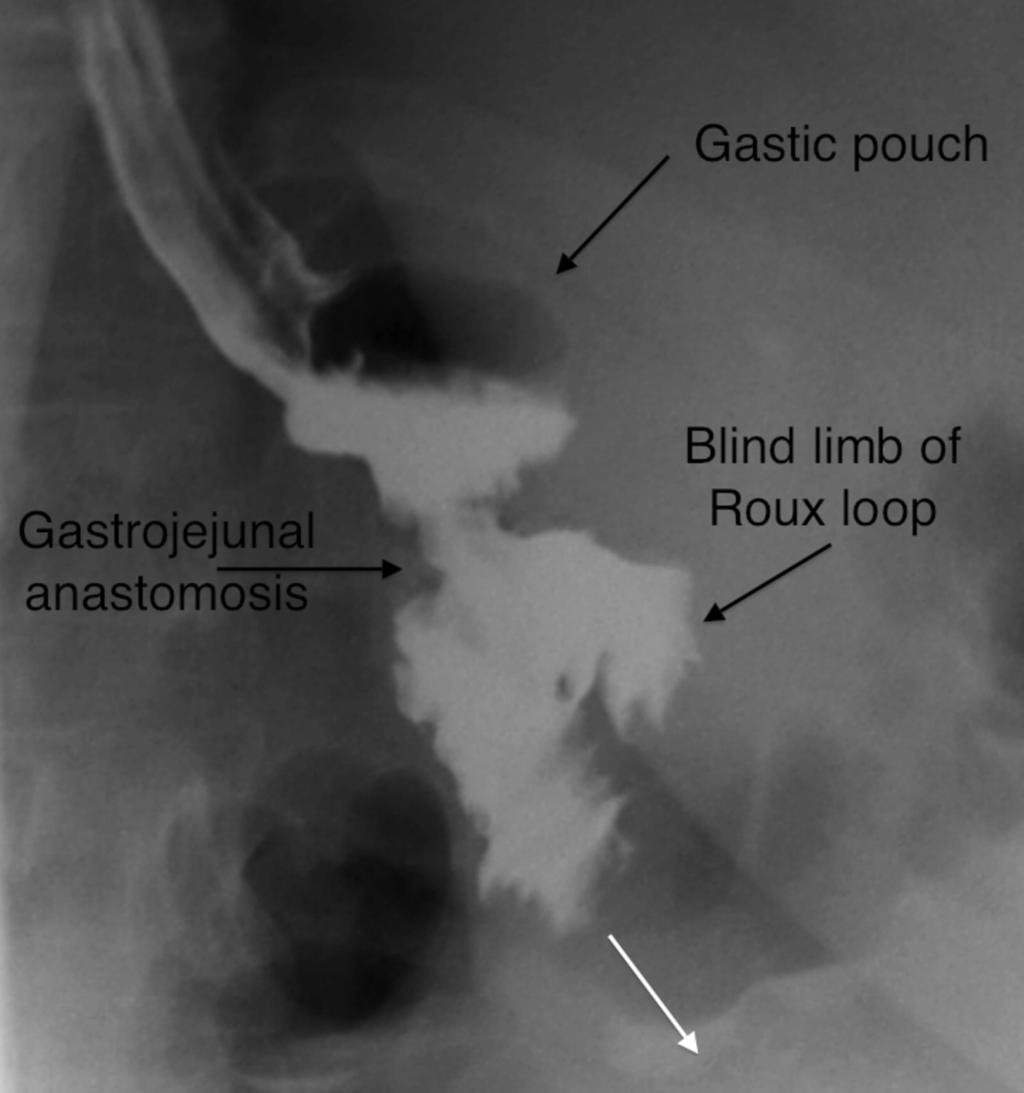 Fig. 13: Normal gastric pouch and gastro-jejunal anastomosis post RYGB.
