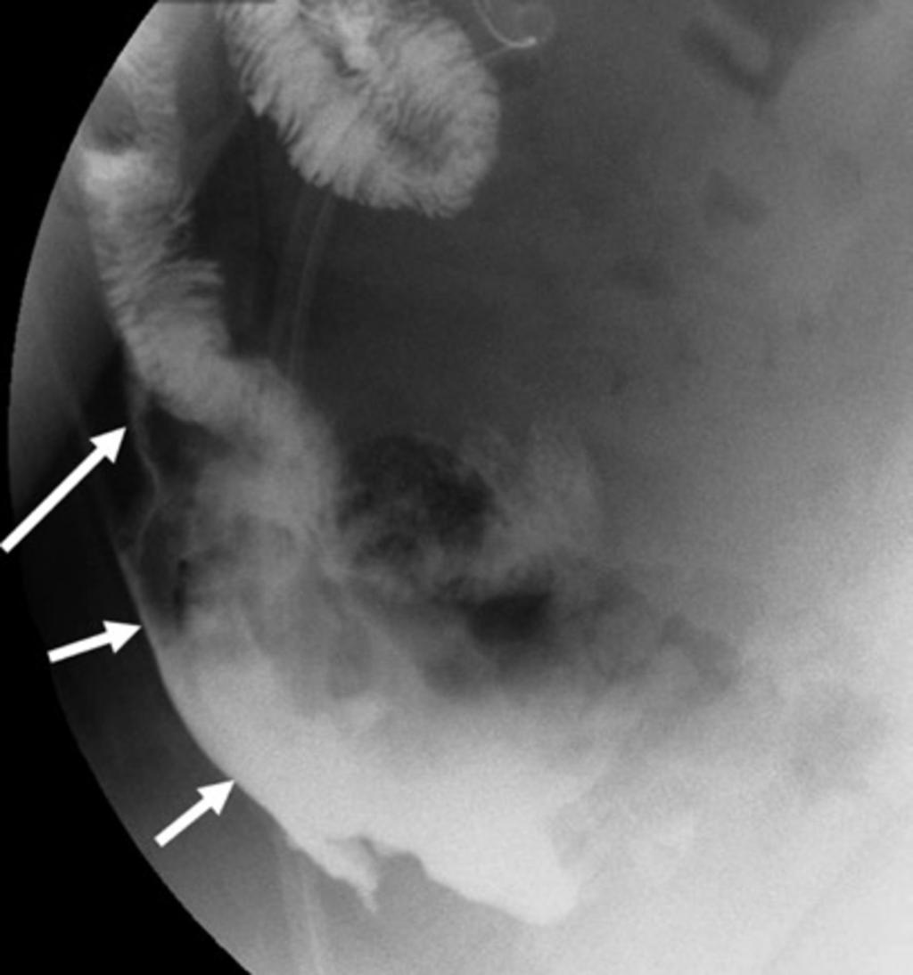 Fig. 14: CT image showing a small left upper quadrant collection (c) following a leak from the gastojejunostomy.