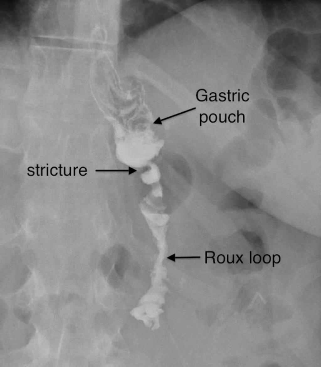 Fig. 16: Gastrojejunal stricture post RYGB. Note the tight narrowing (stricture) of the gastrojejunal anastomosis and the rounded appearance of the gastric pouch.