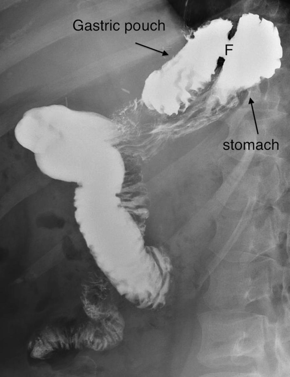 Fig. 17: A fistula (F) has formed between the gastric pouch and excluded stomach with preferential passage of