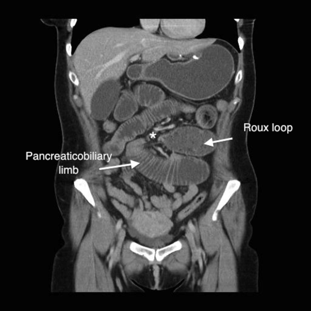 Fig. 19: A coronal image from a CT demonstrating obstruction of both the roux loop and the pancreaticobiliary limb.