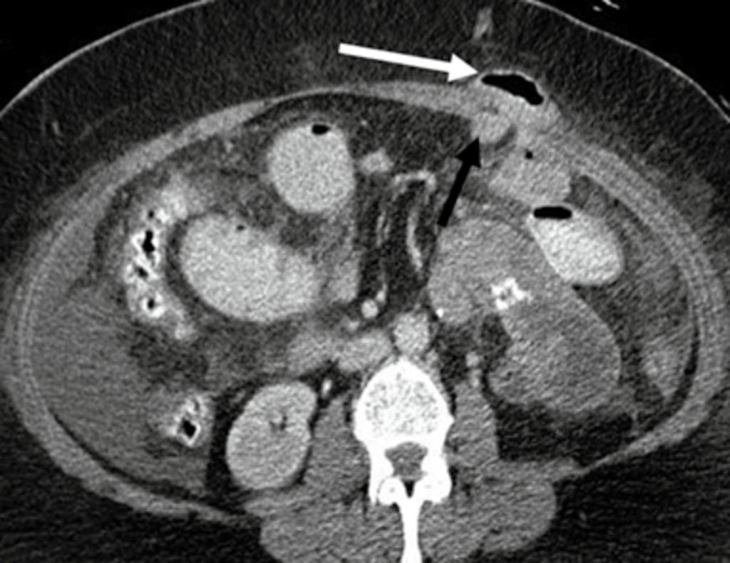 Fig. 20: CT performed for recurrent vomiting post Laparoscopic RYGB shows dilated small bowel loops with an abrupt transition point at a port site hernia in the left anterior abdominal wall (white