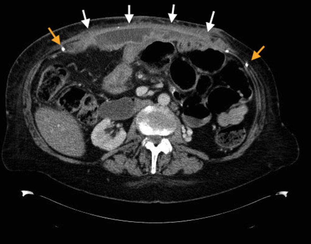 Fig. 21: CT image showing a superficial anterior abdominal collection (white arrows) in a patient who has undergone a mesh hernia repair (note the mesh clips - orange arrows) for an incisional hernia
