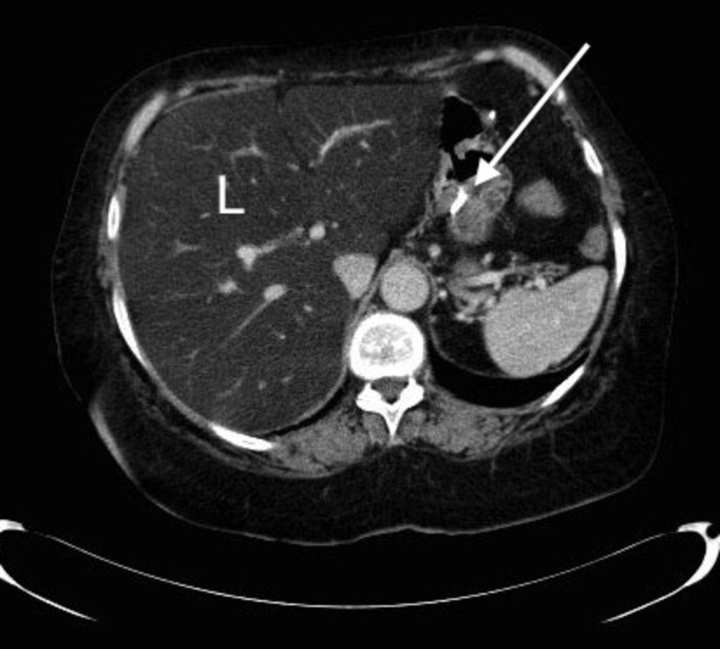 Fig. 22: CT image showing diffuse fatty infiltration of the liver (L) secondary to protein malnutrition.