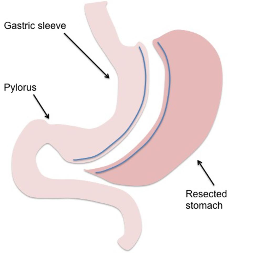to calibrate the size of the gastric sleeve. The excluded fundus and greater curvature are removed. This reduces the size of the stomach by about 75% and produces a restrictive effect (8). Fig.