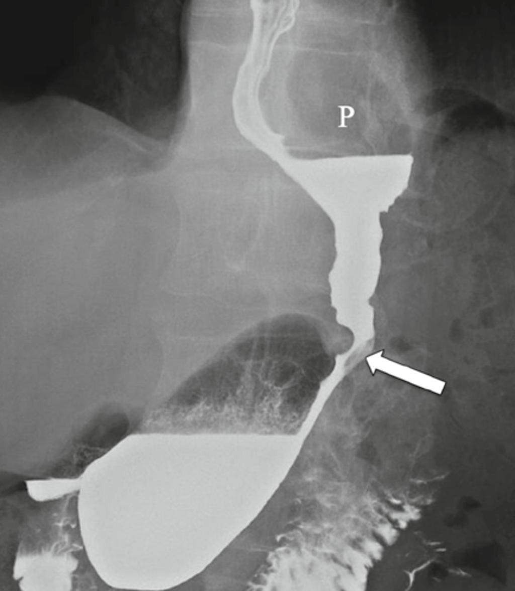 Fig. 25: Contrast swallow shortly after sleeve gastrectomy with a nasojejunal tube in situ. A leak from the proximal end of the gastric tube is demonstrated.