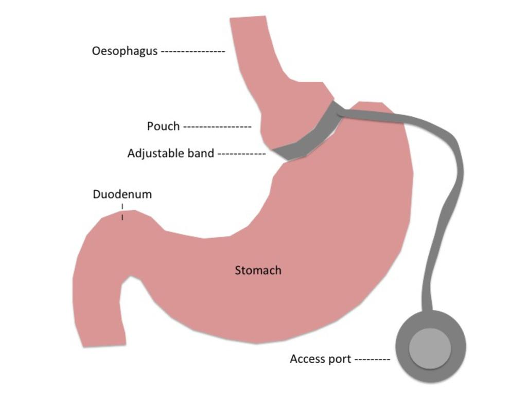 Fig. 1: Laparoscopic Adjustable Gastric Band. The inflatable gastric band is positioned just below the gastro-oesophageal junction to create a small gastric pouch just above it.