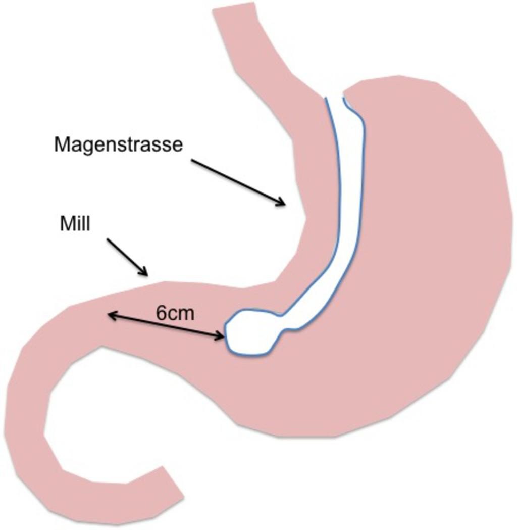 Fig. 27: Magenstrasse and Mill. A "Magenstrasse" (street of the stomach) is the narrow gastric tube created by stapling from the antrum to the fundus. This conveys food to the antral "Mill".