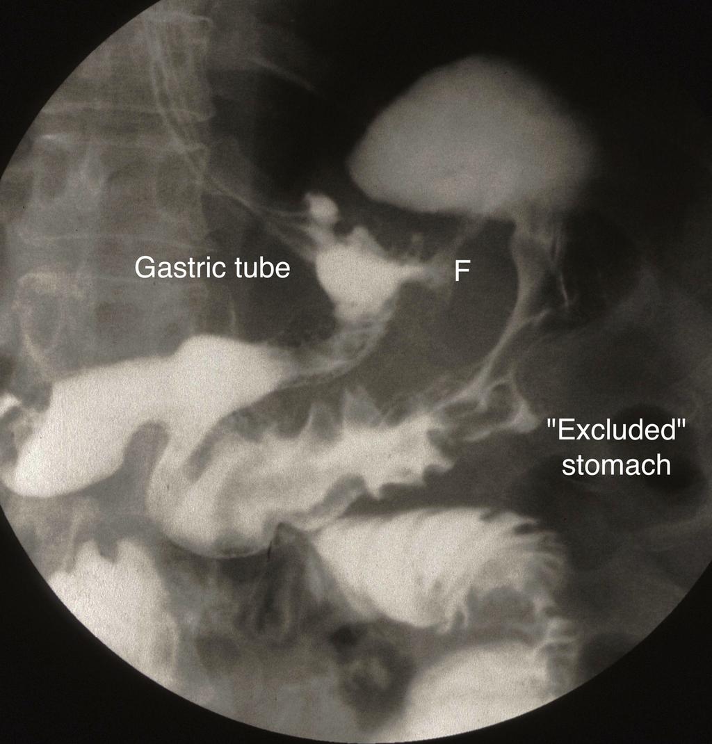A fistula may develop between the Magenstrasse and the excluded stomach due to staple line dehiscence. On barium swallow there is early filling of the excluded stomach prior to filling of the antrum.