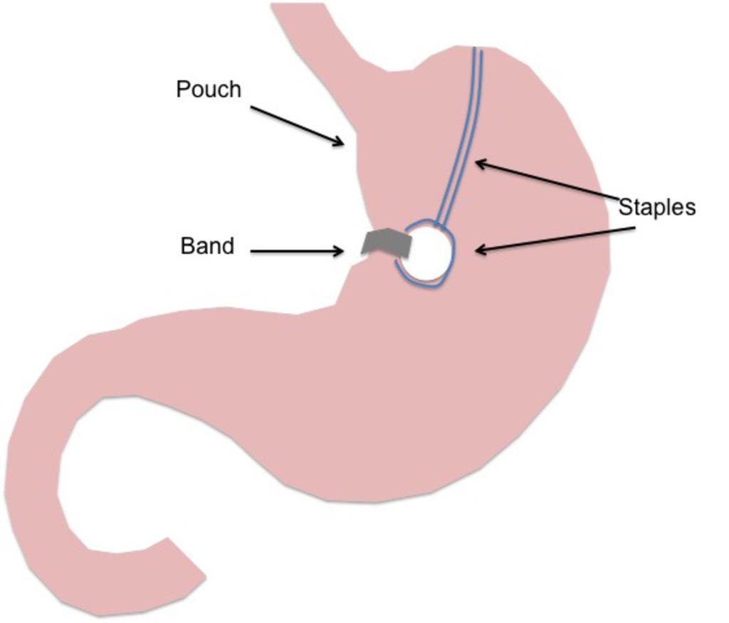 References: - Leeds/UK Vertical Banded Gastroplasty (VBG) Similar to the Magenstrasse and Mill procedure, the vertical banded gastroplasty is another purely restrictive procedure that has been