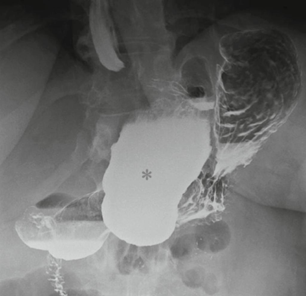 Fig. 37: Recurrent vomiting 10 years after VBG. The band is causing over restriction and gross dilatation of the pouch (*).