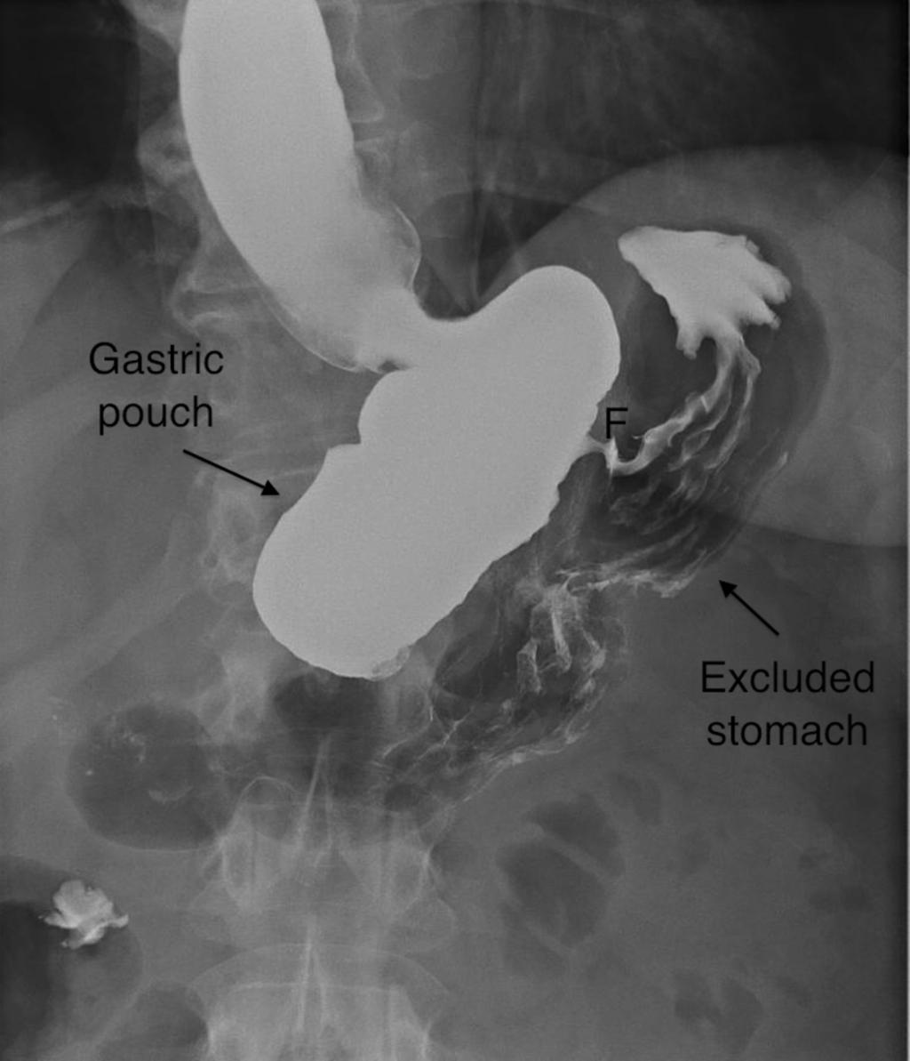 Fig. 32: Disruption of the suture line superiorly with a fistula (F) forming between the gastric pouch and the excluded gastric