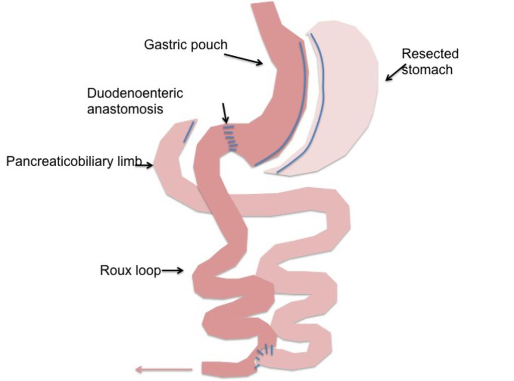 Fig. 33: Duodenal Switch with Biliopancreatic Diversion. The duodenum is divided and the distal small bowel anastomosed to the proximal duodenum.