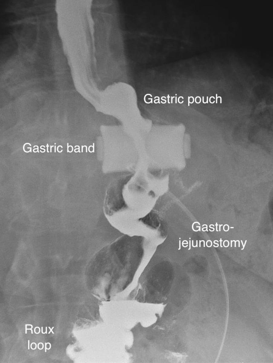 Fig. 35: Barium swallow on same patient as fig 37 demonstrating the gastric band