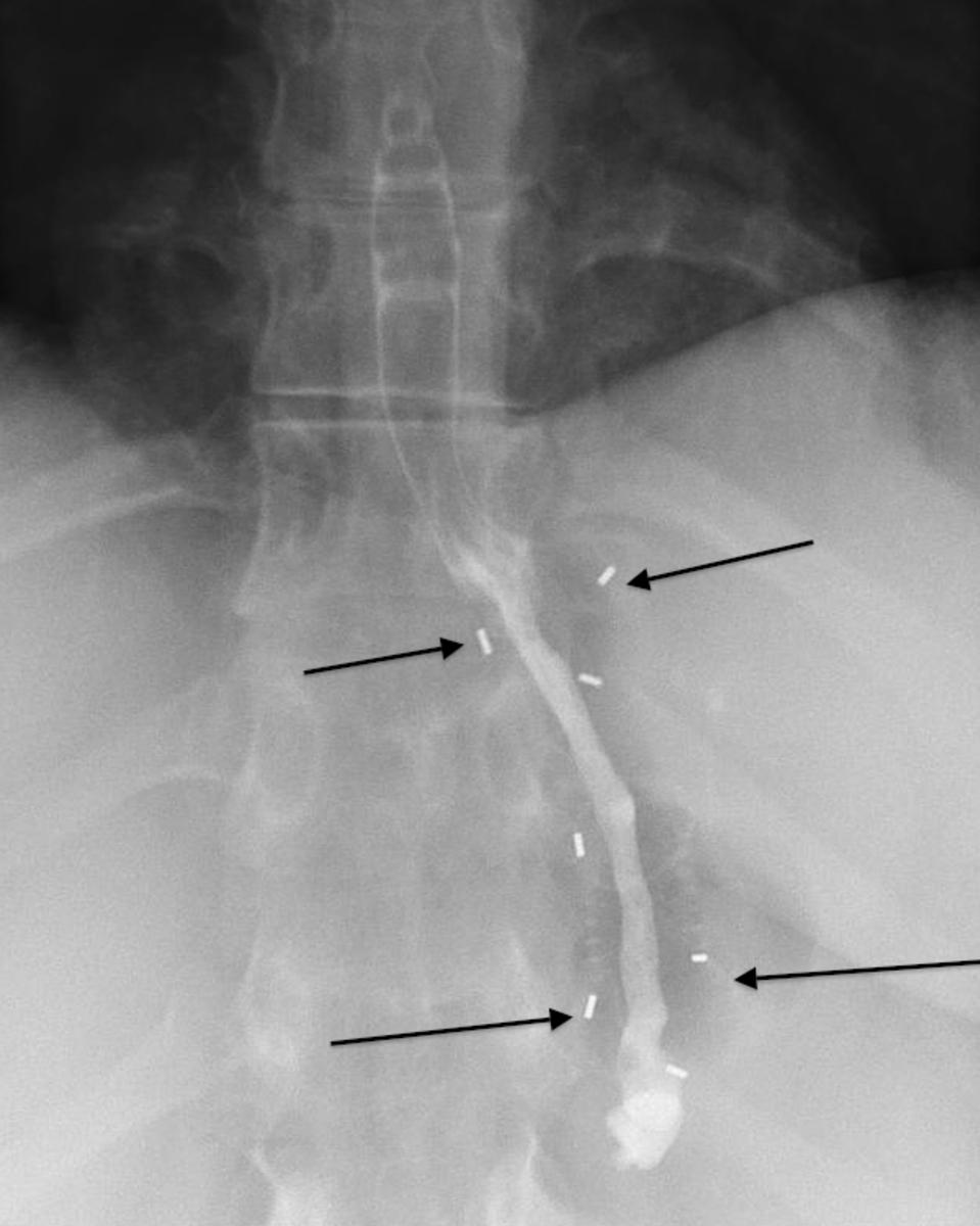 Fig. 36: A stent (black arrows) has been placed to treat a post RYGB stricture.