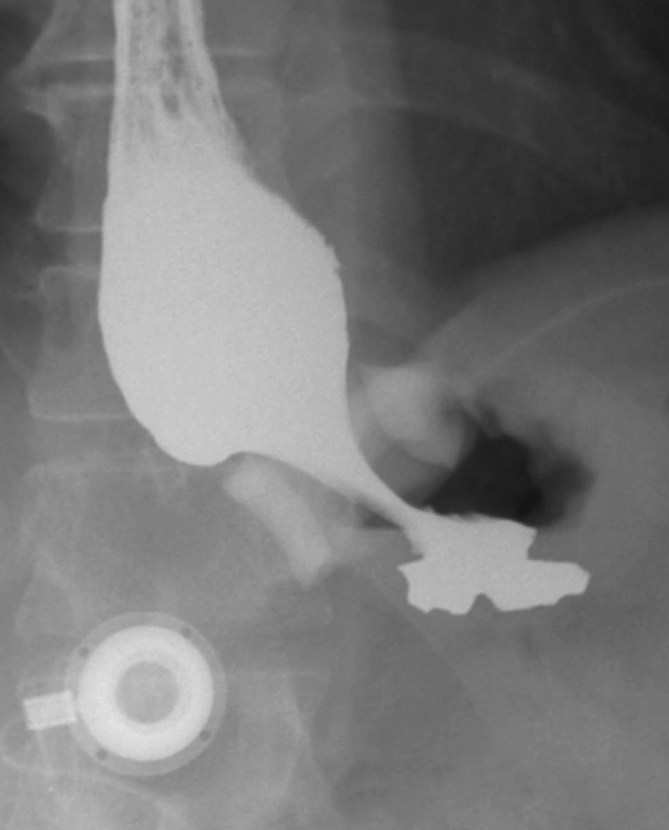 Fig. 4: Normal post-operative imaging of a LAGB.