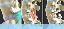 The procedure fixes the vertebral bones in an ideal position and limits movement that can cause pain. (Refer figure. 1) Wear and tear Compress or damage Lower back pain (Figure.