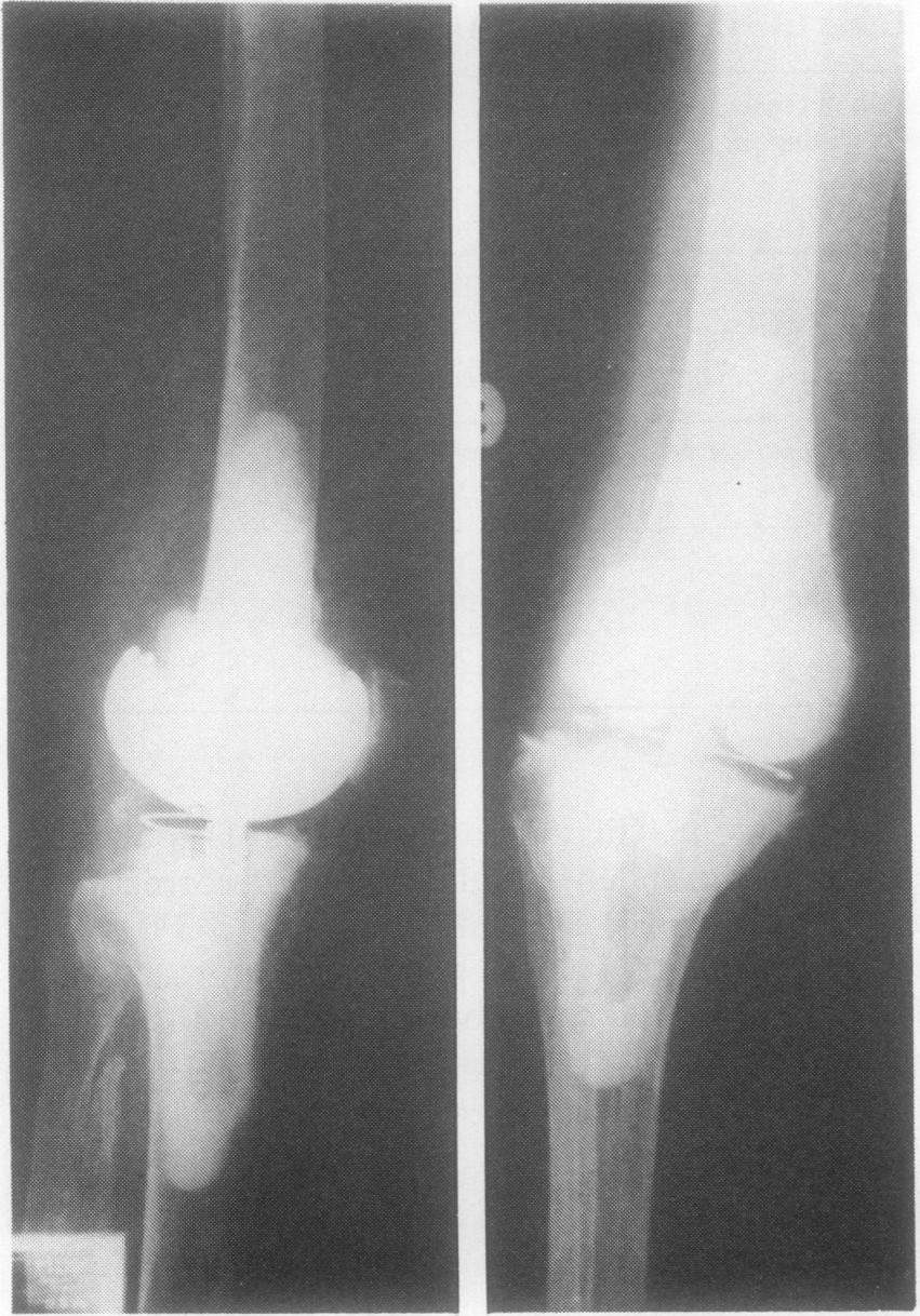 420 Arden L I Fig. 6 This rheumatoid patient had an Attenborough total knee replacement ofboth knees and 3 years later had flexion in both knees to 900 and no pain.