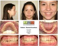 Stage 1: : Procline max incisors followed by functional appliance Stage 2: