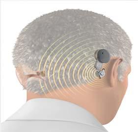 disorders BONEBRIDGE in SSD - BONEBRIDGE implanted on the deaf side - Stimulation of the contralateral inner