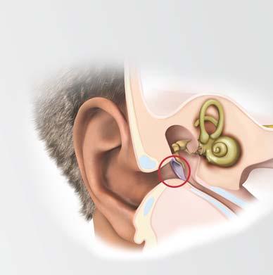 Type of Hearing Loss Type of Hearing Loss Conductive: Problem with the