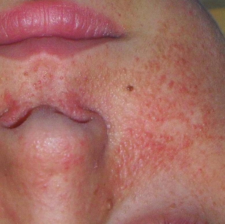 What are facial angiofibromas (skin lesions / growths)? Angiofibromas are overgrowths of skin. They are usually scattered on the nose and cheeks.