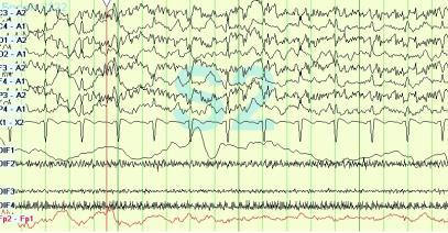 PSG in PDOC- Stage 2 PSG in PDOC- REM Stage 2 sleep: Identified by presence of spindles which is usually in the 6-9 Hz frequency range REM: Identified by muscular atonia, lack of spindles and