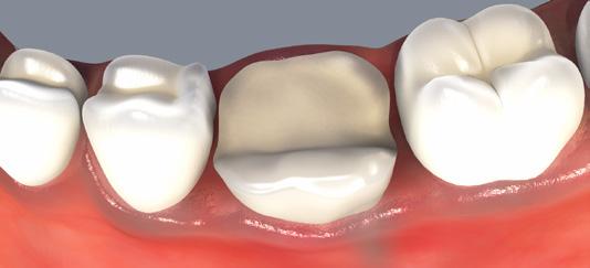 Then reduce any obvious opposing cusps that might cause occlusal interference. Open the appropriate OVC case (Figure C).