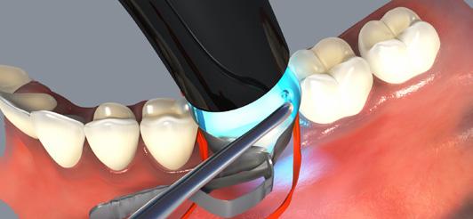 2 Optibond FL (Kerr Dental) or Clearfil SE Bond (Kuraray Dental) are recommended.