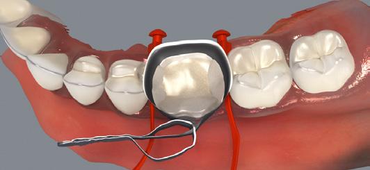 Use a ball burnisher to hold matrix band against adjacent tooth then cure. Repeat for distal (Figure H).