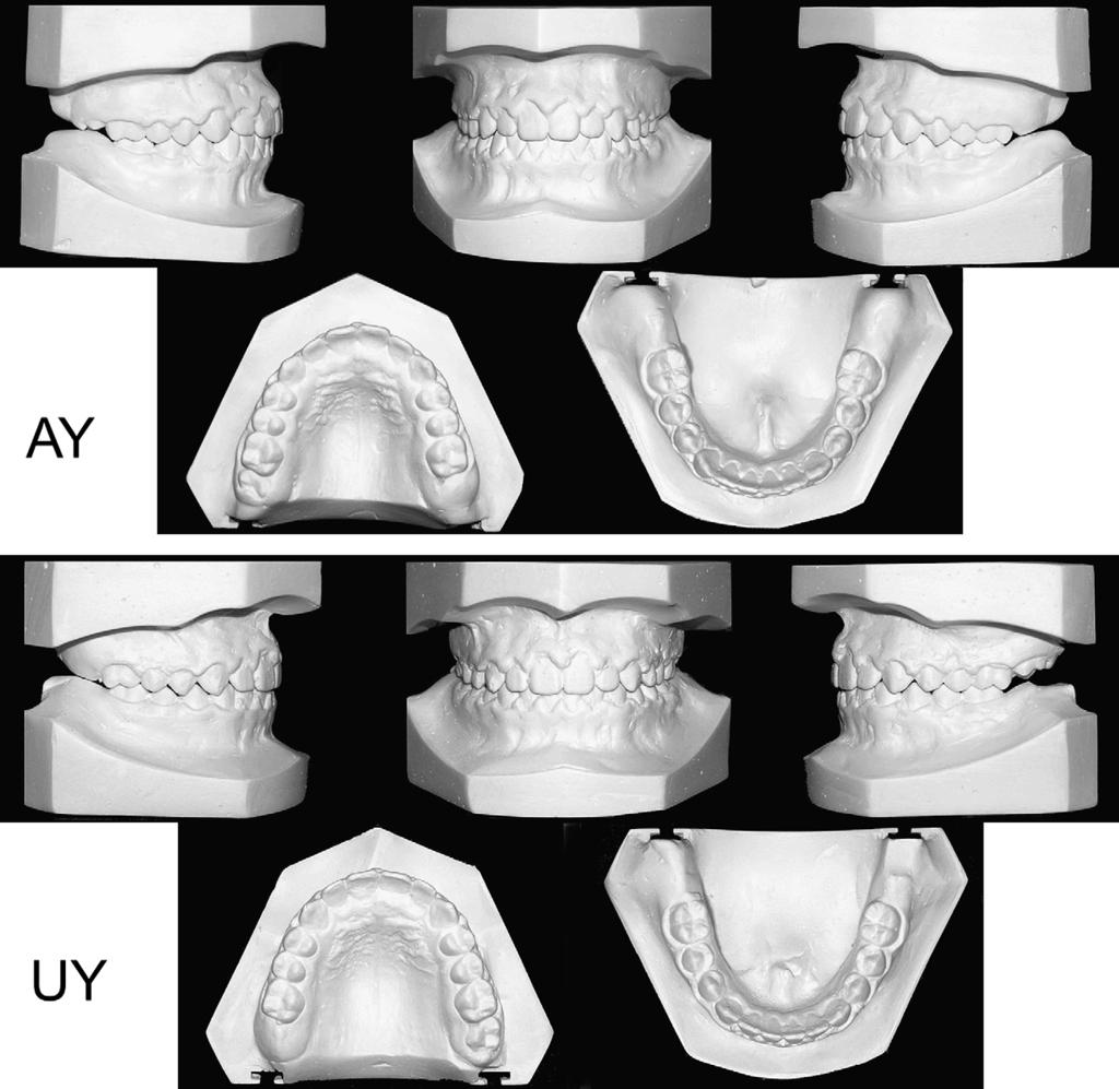American Journal of Orthodontics and Dentofacial Orthopedics Babacan, Ozt urk,