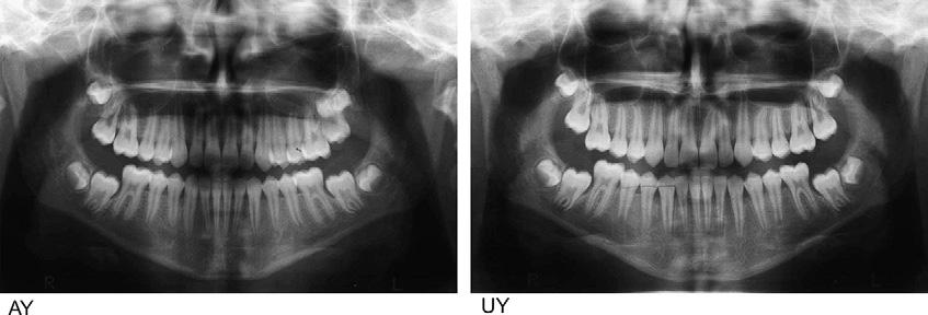 508 Babacan, Ozt urk, and Polat American Journal of Orthodontics and Dentofacial Orthopedics October 2010 Fig 13.