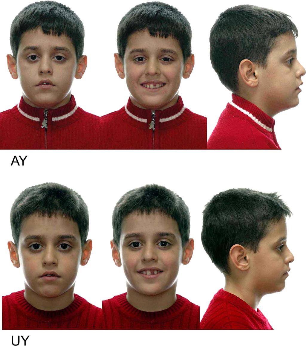 American Journal of Orthodontics and Dentofacial Orthopedics Babacan, Ozt urk, and Polat 499 Volume 138, Number 4 Fig 1. Pretreatment facial photographs of AY and UY.