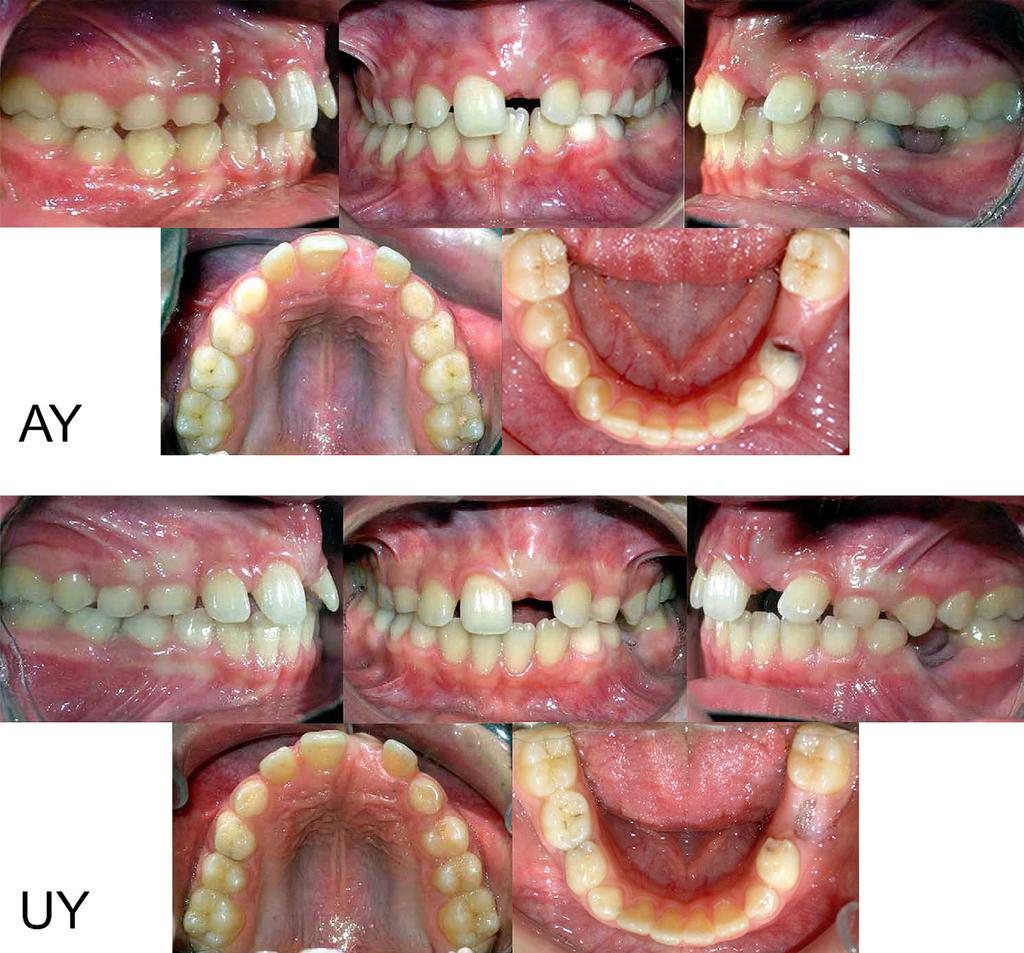 500 Babacan, Ozt urk, and Polat American Journal of Orthodontics and Dentofacial Orthopedics October 2010 Fig 2. Pretreatment intraoral photographs of AY and UY.