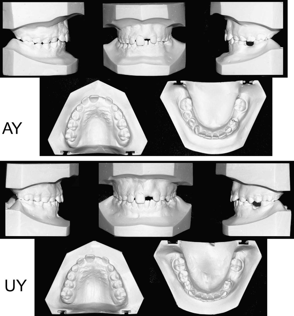 American Journal of Orthodontics and Dentofacial Orthopedics Babacan, Ozt urk, and Polat 501 Volume 138, Number 4 Fig 3. Pretreatment dental casts of AY and UY.