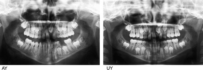 502 Babacan, Ozt urk, and Polat American Journal of Orthodontics and Dentofacial Orthopedics October 2010 Fig 4.
