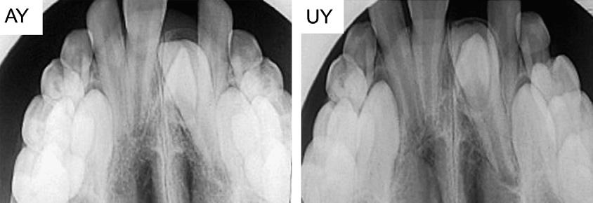 Pretreatment periapical radiographs of AY and UY.