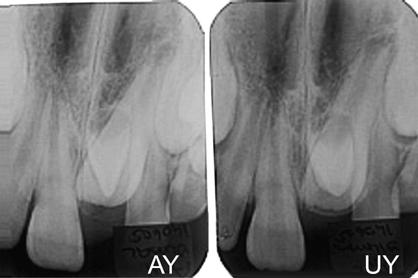 with pleasant smiles (Fig 10). Class I molar and canine relationships, and ideal overjet and overbite were achieved.