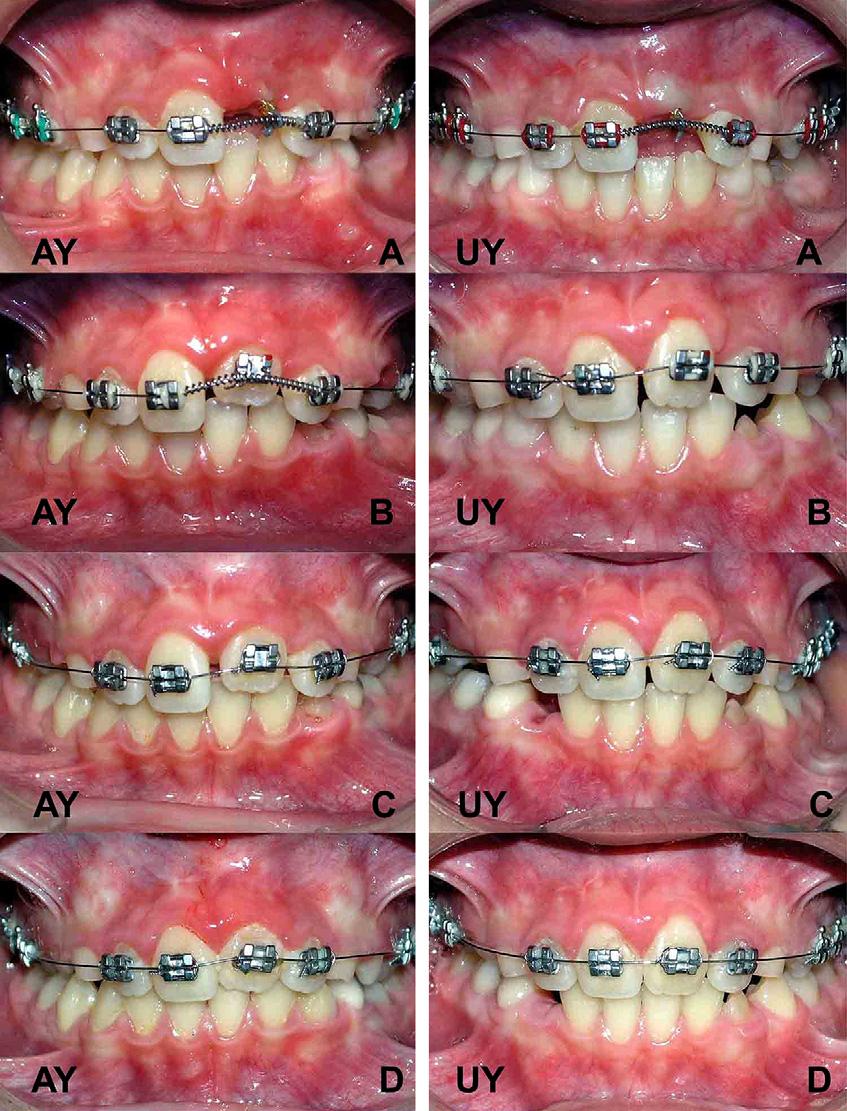 504 Babacan, Ozt urk, and Polat American Journal of Orthodontics and Dentofacial Orthopedics October 2010 Fig 9. Orthodontic traction of impacted central incisors.