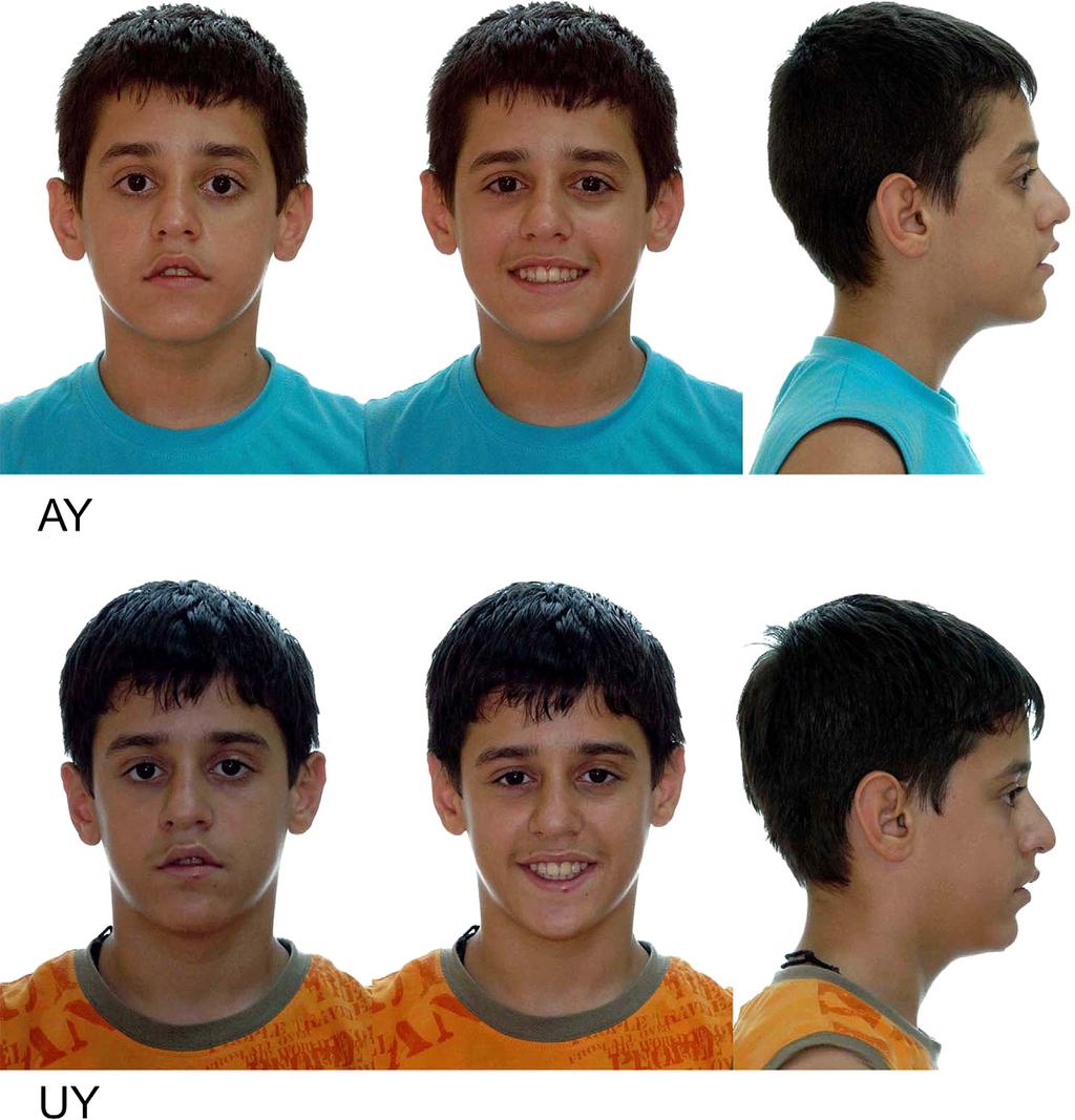 American Journal of Orthodontics and Dentofacial Orthopedics Babacan, Ozt urk, and Polat 505 Volume 138, Number 4 Fig 10. Posttreatment facial photographs of AY and UY.