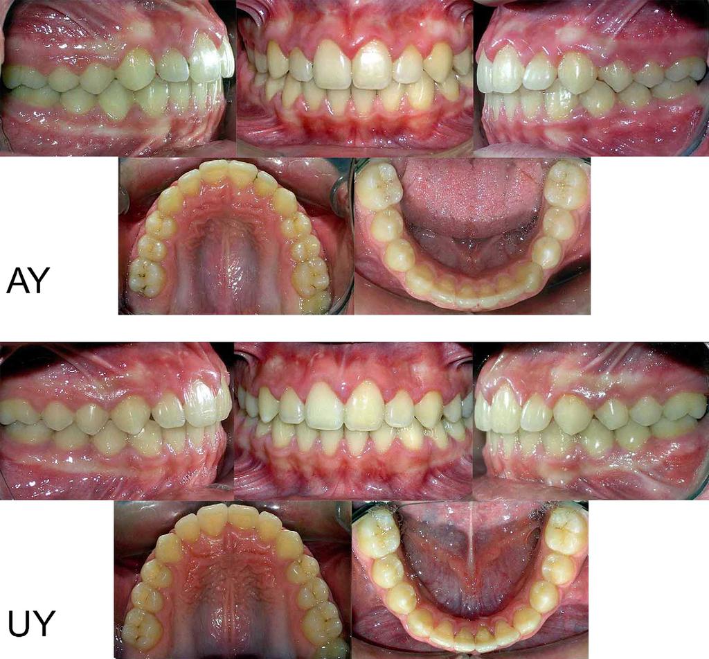 506 Babacan, Ozt urk, and Polat American Journal of Orthodontics and Dentofacial Orthopedics October 2010 Fig 11. Posttreatment intraoral photographs of AY and UY.