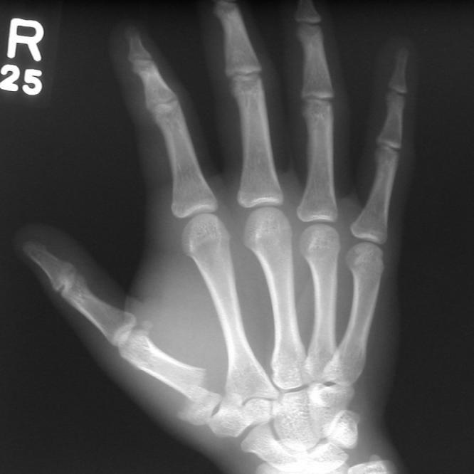 Fractures of the Hand in Children Which are simple? And Which have pitfalls?