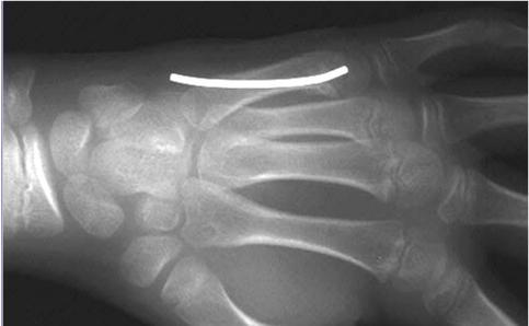 Fig. 19a-b. Metacarpal shaft closed reduction. a. Injury image demonstrating apex dorsal angulation. b.