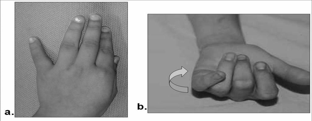 This is usually apparent on the initial clinical examination. b. Rotation. Unless looked for carefully, this may be overlooked. Fig. 13. Associated deformities of proximal phalangeal fractures. a. Angulation.