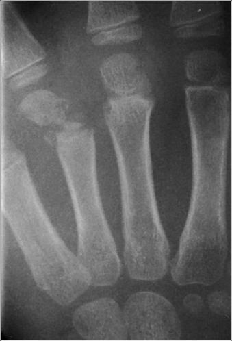 c. X-ray of comminuted Salter-Harris II-III fracture pattern d. Following open reduction. 2. Fractures of the metacarpal neck. a.
