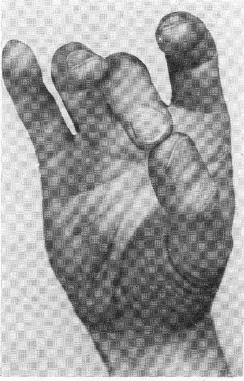 (particularly those with short thumbs) as to resemble the hand of a patient with rheumatoid ulnar drift (Fig. 1).
