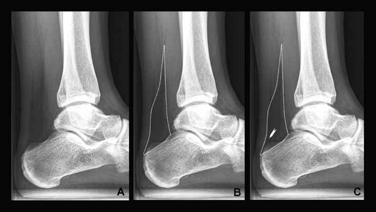 negative for the appearance of the retrocalcaneal recess (measurement 1).