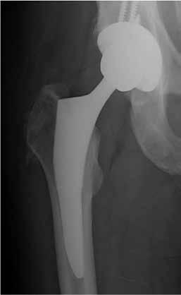 There was no clinical difference in mean pain scores or mean Harris Hip Scores among the three proximal femoral shapes; Dorr A, B, and C.