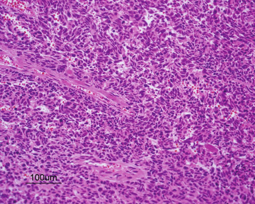 4 Case Reports in Surgery (a) (b) (c) (d) Figure 3: Histopathological examination shows that the tumor comprises a main small cell carcinoma component (a) and a smaller squamous cell carcinoma